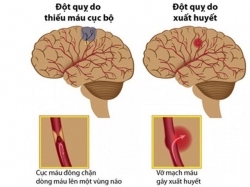 Các phương pháp phòng tránh tai biến mạch máu não